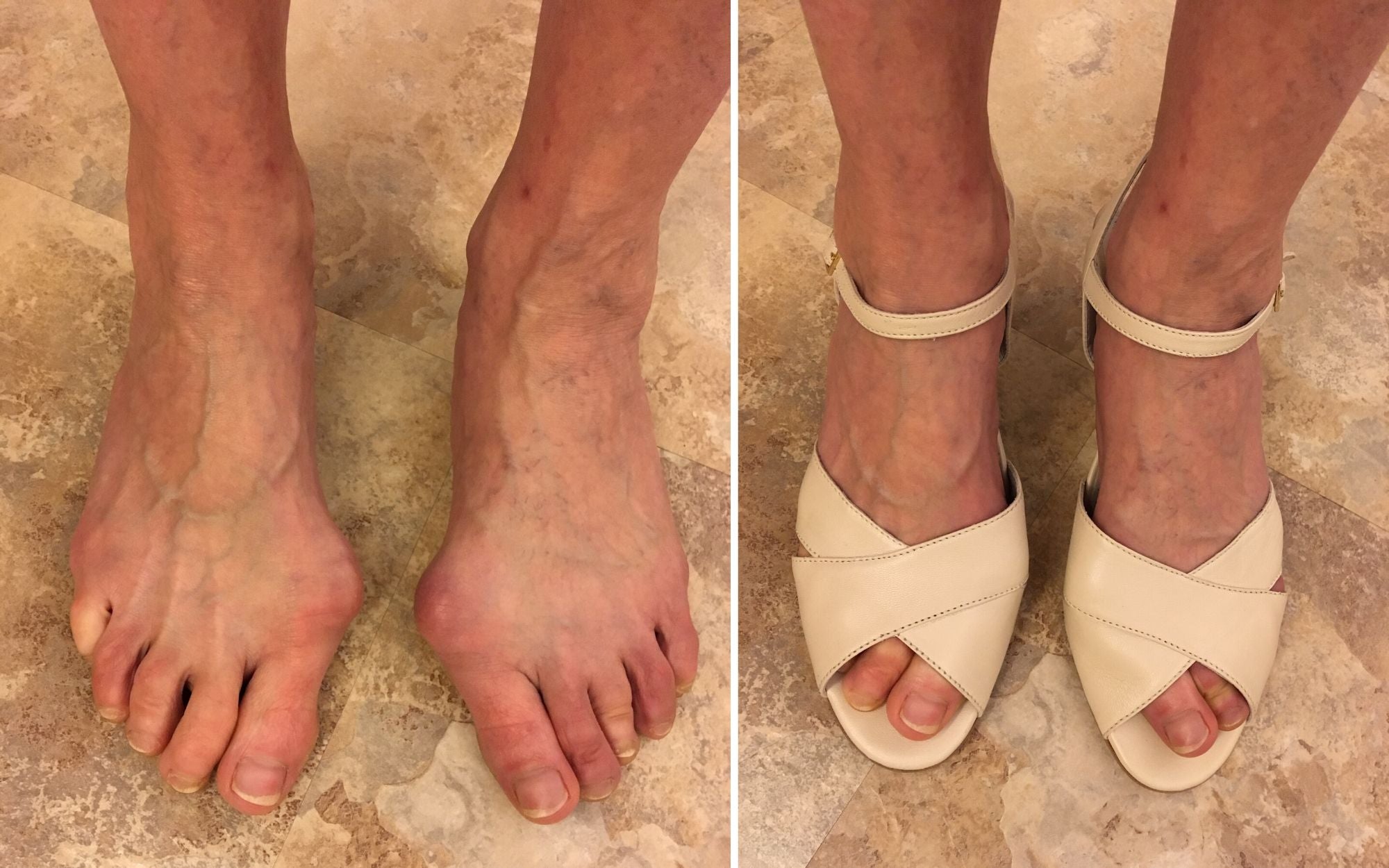 heels for bunions stylish and comfortable customer review