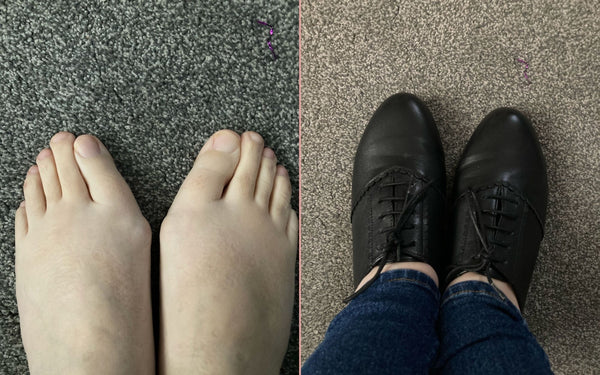 feet with bunions in and out of shoes