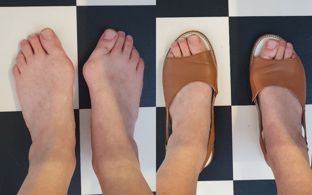 review of calla shoes for bunions