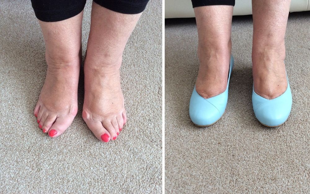 review of calla customer wearing blue flats for her bunions