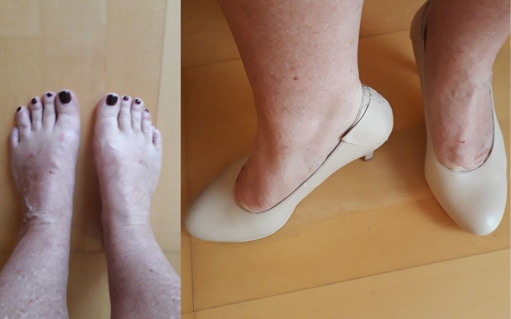 review of calla shoes for bunions