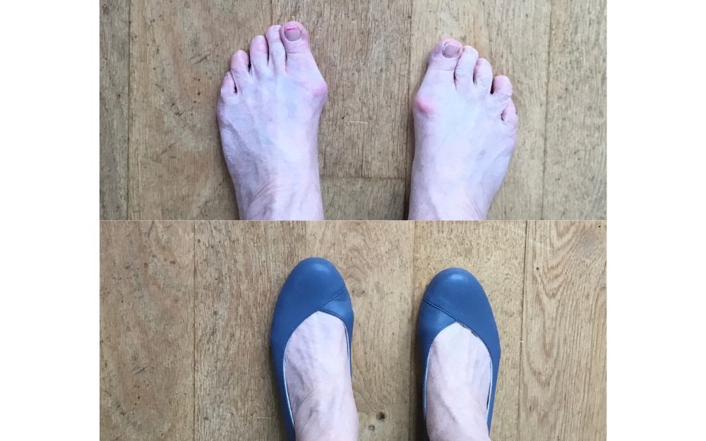 photo review of calla shoes for bunions
