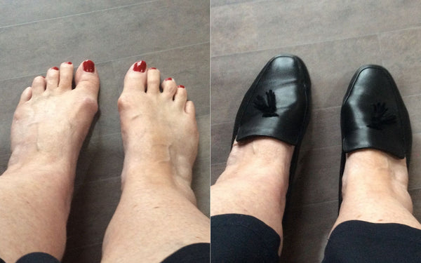 happy customer review of calla shoes for bunions