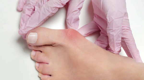 myths and facts on how to get rid of bunions on feet