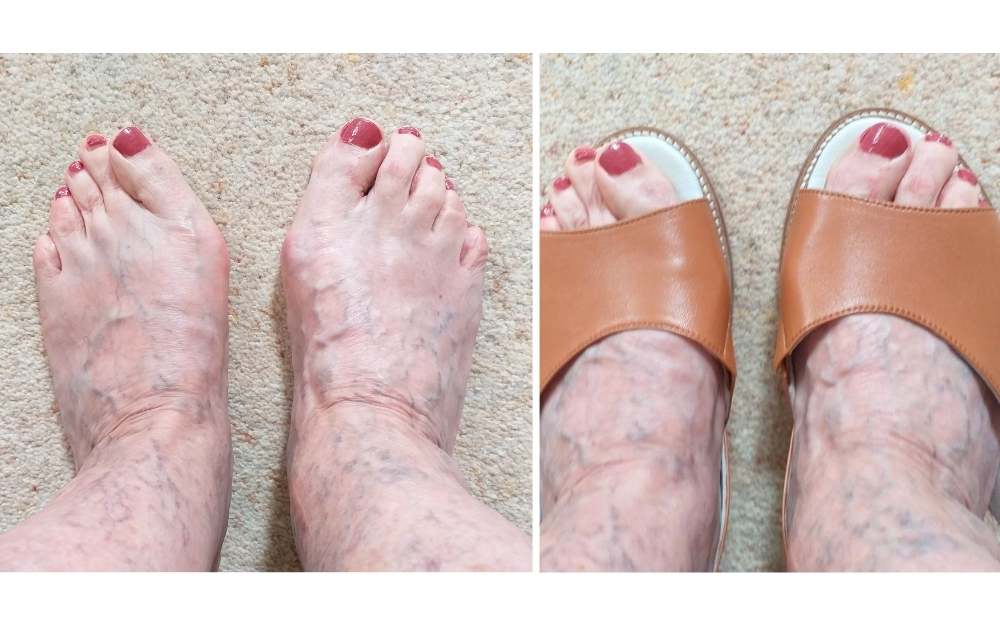 review of calla shoes for bunions by customer 