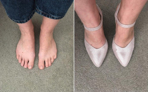 review of calla shoes for bunions by customer 
