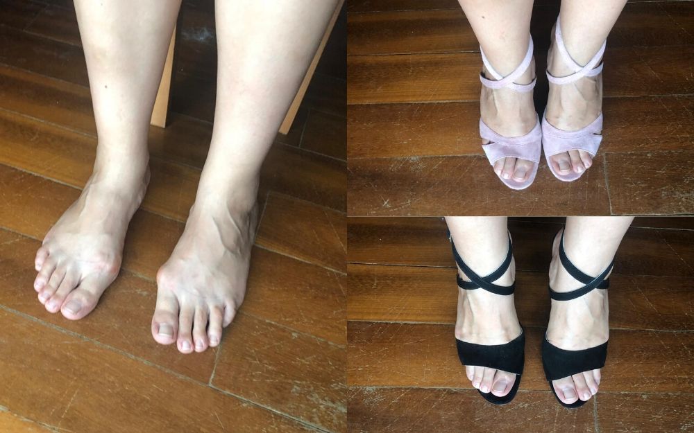 review of calla shoes for bunions