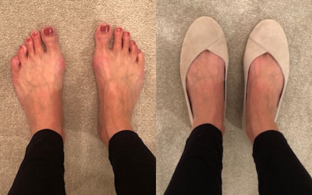 review of calla shoes for bunions