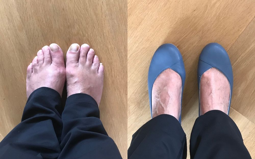 review of calla shoes for bunions