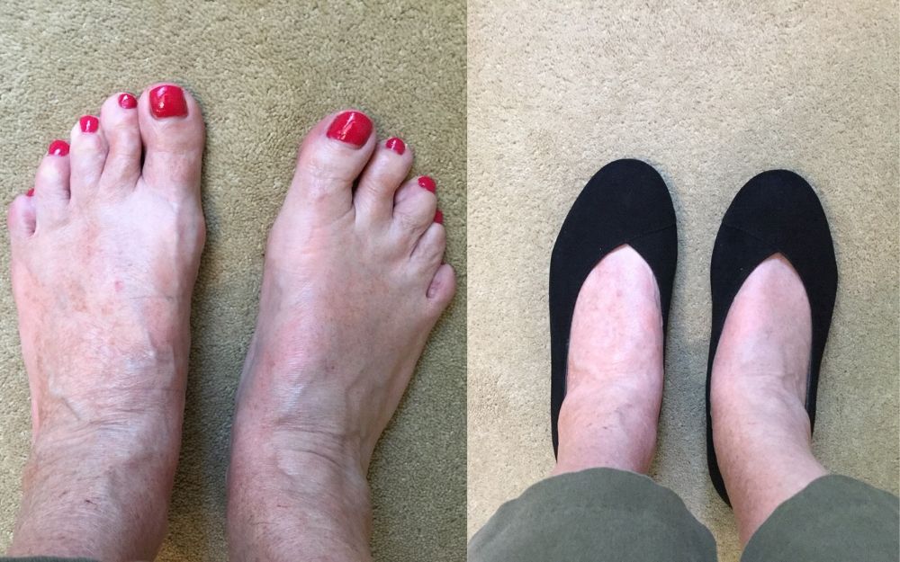 review of black shoes for bunions