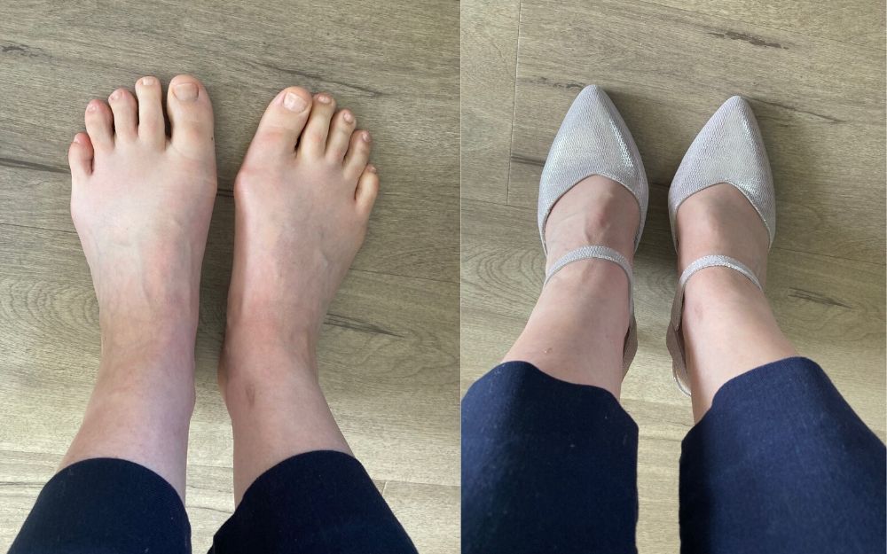 review of calla shoes for bunions