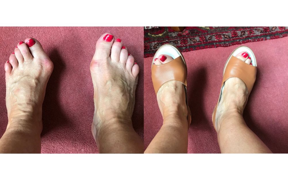 review of calla shoes for bunions