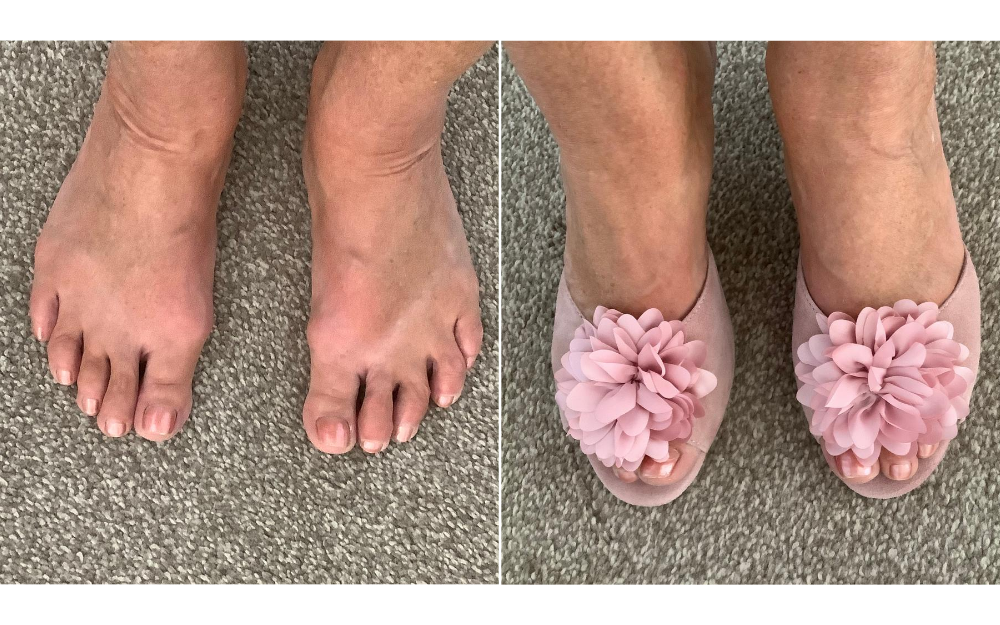 review of calla shoes for bunions