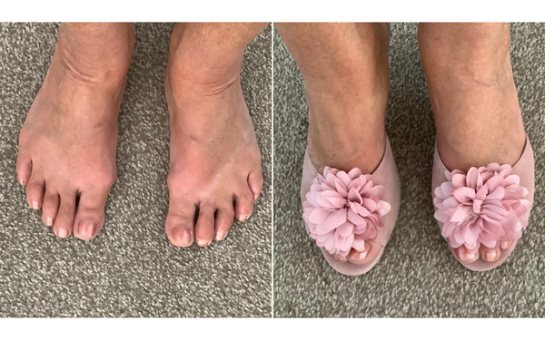review of calla shoes for bunions
